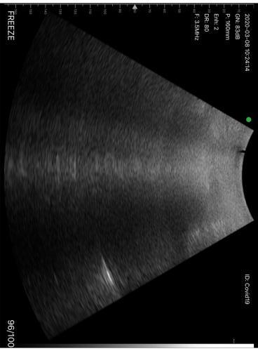 Ecografia polmonare  - diagnosi covid-19 con sonda ecografica wireless ATL (1)