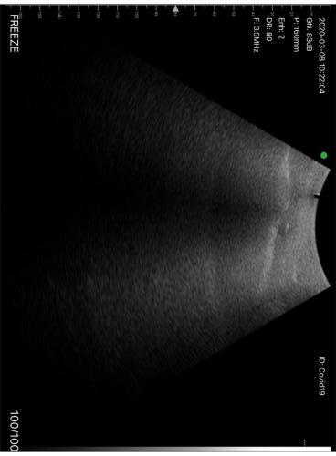 Ecografia polmonare  - diagnosi covid-19 con sonda ecografica wireless ATL (5)