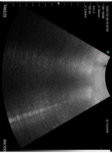 Ecografia polmonare  - diagnosi covid-19 con sonda ecografica wireless ATL (7)